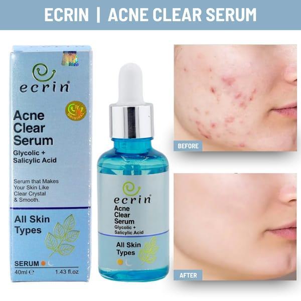 Acne Clear Serum -40ml